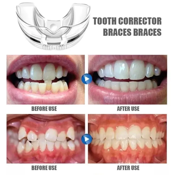 Smooth%20Dental%20Orthodontic%20Teeth%20Corrector%20l%20Dental%20Care%20Kit%20/%20Mouth%20Guard%20Braces%20Retainer%20Straighten%20Tool%20-%20Image%203