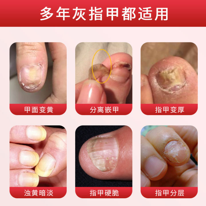 Spot%20wholesale%20nail%20fungus%20special%20liquid%20spray%20gray%20toenail%20bad%20nail%20thick%20nail%20antibacterial%20spray%20Douyin%20with%20the%20same%20style%20-%20Image%204