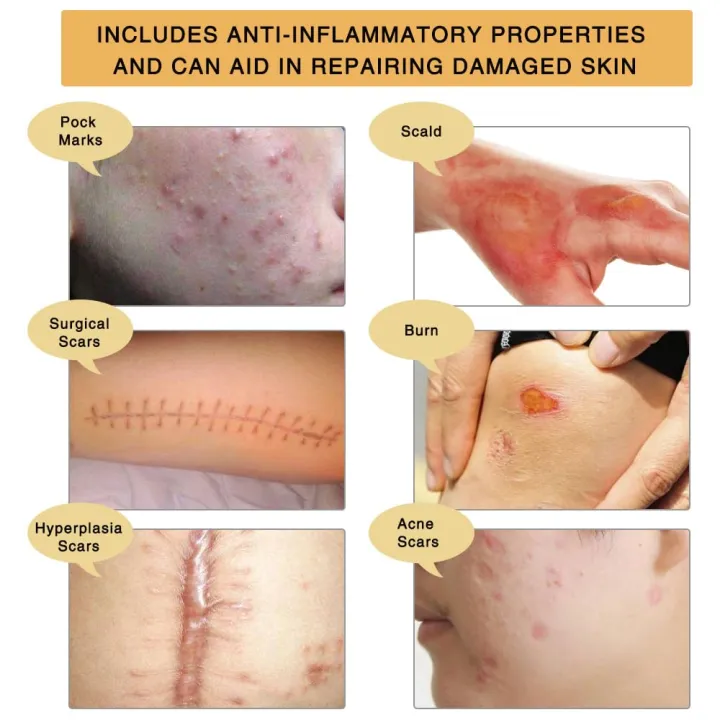 Original%20Scar%20and%20Acne%20Mark%20Removal%20Gel%20Stretch%20Marks/acne/scald/surgical%20Scars%20Treatment%20Cream%20Skin%20Care%2030%20Gram%20-%20Image%204