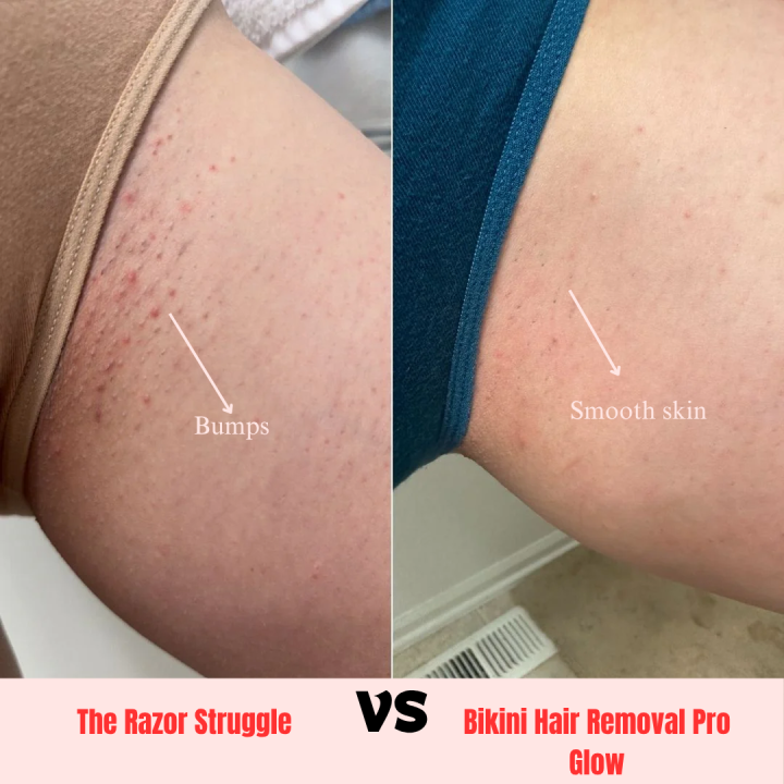Girls%20Select%20Original%20Bikini%20Hair%20Removal%20For%20Whole%20Body%20Part,%20Smooth%20And%20Soft%20Skin,%20FREE%20Travel%20Pouch,%20Battery%20operated%20No%20Cuts%20No%20Ouchs%20-%20Image%203