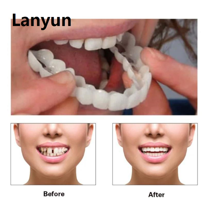 Lanyun Tooth Cover Perfect Fit Teeth Whitening Teeth Snap on Silicone ...