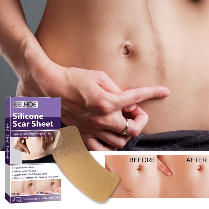Scar%20Treatment%20Silicone%20Gel%20Sheet%20Eliminate%20Stretch%20Mark%20Scald%20Burn%20Scar%20Removal%20Acne%20Trauma%20Skin%20Repair%20Fade%20Surgery%20Scar%20Patch%20-%20Image%203