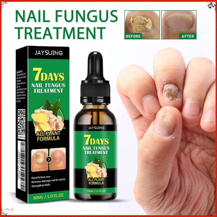 Jaysuing%20for%20Treating%20Gray%20Nails%20Nail%20Care%20Solution%20Ginger%20Essence%20-%20Image%202