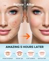 200 Patches Acne Cover  Pimple Patches for Face, Hydrocolloid Acne Patches, Cute Star Zit Covers for Face. 