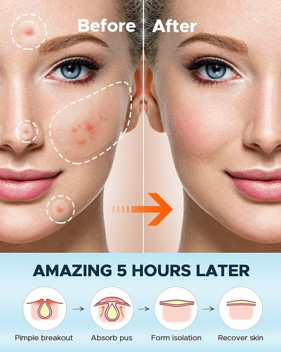 200%20Patches%20Acne%20Cover%20%20Pimple%20Patches%20for%20Face,%20Hydrocolloid%20Acne%20Patches,%20Cute%20Star%20Zit%20Covers%20for%20Face%20-%20Image%207