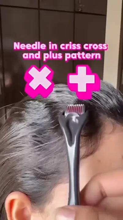 0.5mm%20Derma%20Roller%20for%20Hair%20&%20Beard%20Growth%20%7C%20Titanium%20Micro%20Needle%20Roller%20for%20Hair%20Regeneration,%20Skin%20Care,%20Acne%20Scars,%20Wrinkles,%20Dark%20Circles%20%7C%20EasyGlow%20Microneedle%20Therapy%20Tool%20-%20Image%207