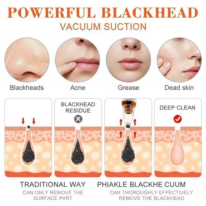 Original%206-in-1%20Blackhead%20Remover%20Vacuum%20%E2%80%93%20Rechargeable%20Electric%20Pore%20Cleaner%20%7C%20Acne,%20Pimple,%20Black%20Spot%20Suction%20Device%20-%20Image%203