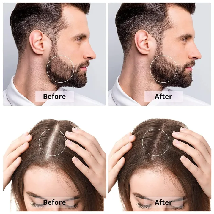 0.5mm%20Derma%20Roller%20540%20Micro%20Needle%20Therapy%20Skin%20For%20Hair%20Treatment%20and%20Face%20-%20Image%207