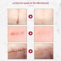 Original Scar and Acne Mark Removal Gel Stretch Marks/acne/scald/surgical Scars Treatment Cream Skin Care. 