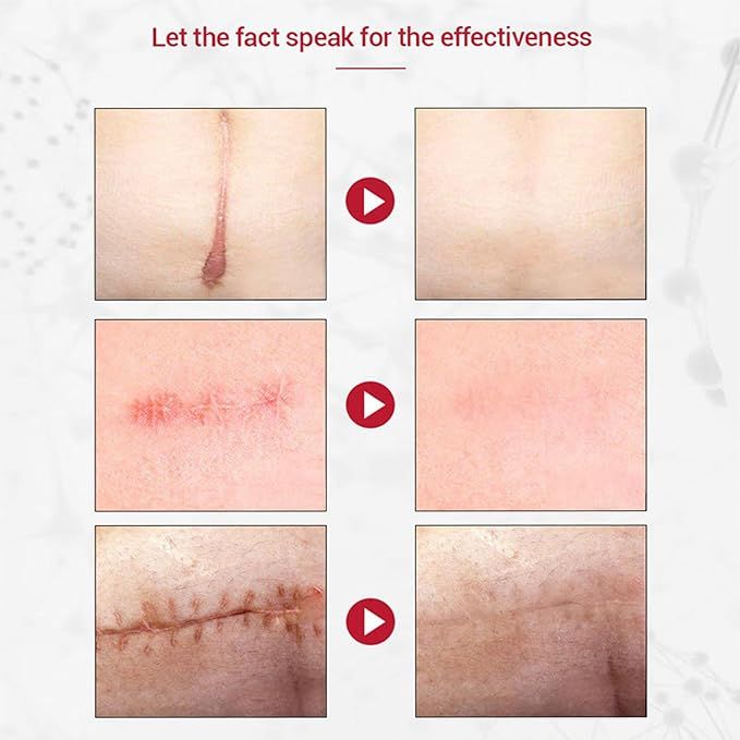 Original%20Scar%20and%20Acne%20Mark%20Removal%20Gel%20Stretch%20Marks/acne/scald/surgical%20Scars%20Treatment%20Cream%20Skin%20Care%20-%20Image%206