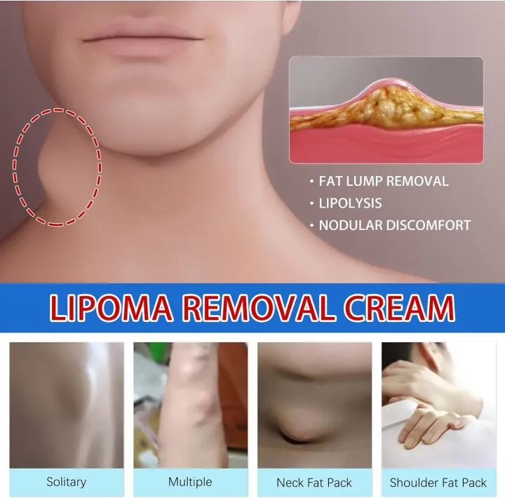 South%20Moon%20LumpFree%20Lipoma%20Removal%20Cream%20And%20Moisturizers-20g%20-%20Image%205