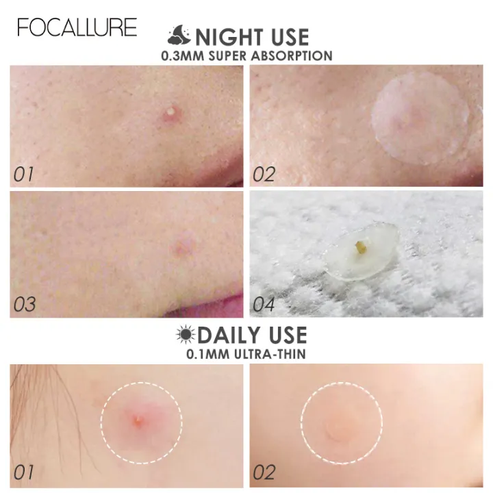 Focallure%20-%20Focallure-FA186%20ACNE%20Pimple%20Daily%20Patch%20-%20Image%207