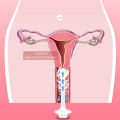 Vaginal Cleansing Douche, Vaginal Syringe Cleaner Empty Bottle for Puerpera Period. 