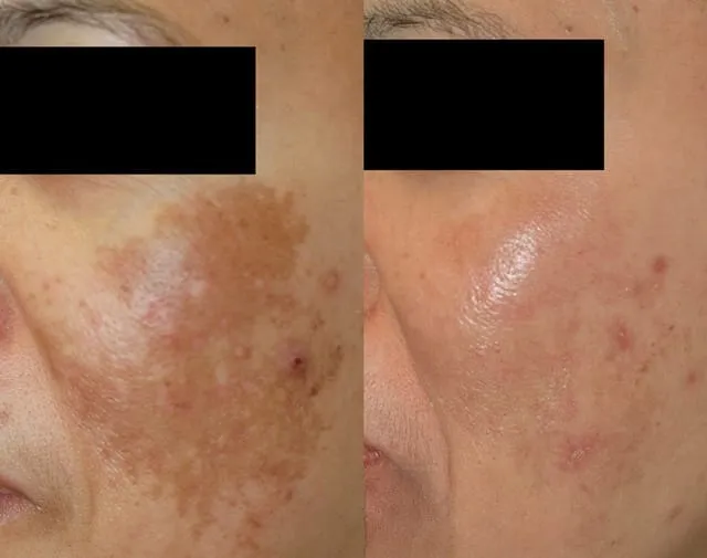 Eternalix%20Plus%20Anti%20Melasma%20Serum%20%7C%20Clinically%20Proven%20Melasma%20Remover%20Serum%20For%20Face%20%7C%20Skin%20Brightening%20&%20Dark%20Spot%20Remover%20With%20Tranexamic%20Acid%20%7C%20Best%20Melasma%20Treatment%20In%20Pakistan%20For%20Hyperpigmentation%20&%20Uneven%20Tone.%20-%20Image%203