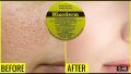 Nixoderm cream For Skin Problem (20G). 