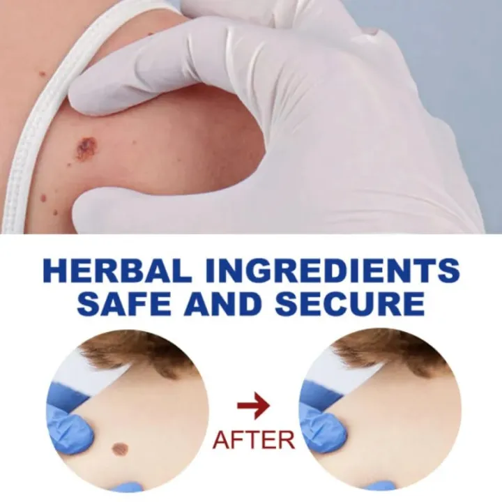 Skin%20Tag%20eye%20Wart%20Mole%20Remover%20Pen%20Woman%20Skin%20Care%20Removing%20Against%20Moles%20Pimple%20Patch%20Remove%20Black%20Dot%20FLAIREX%20-%20Image%208