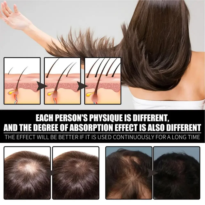 FORT%20%20Minoxidil%20Hair%20Growth%20Spray%20-%20Hair%20Tonic%20for%20Hair%20Care%20and%20Hair%20Growth%20-%20Premium%20Hair%20Care%20ProductWomen%20and%20Men%20all%20Hair%20Types%20-%20Image%205