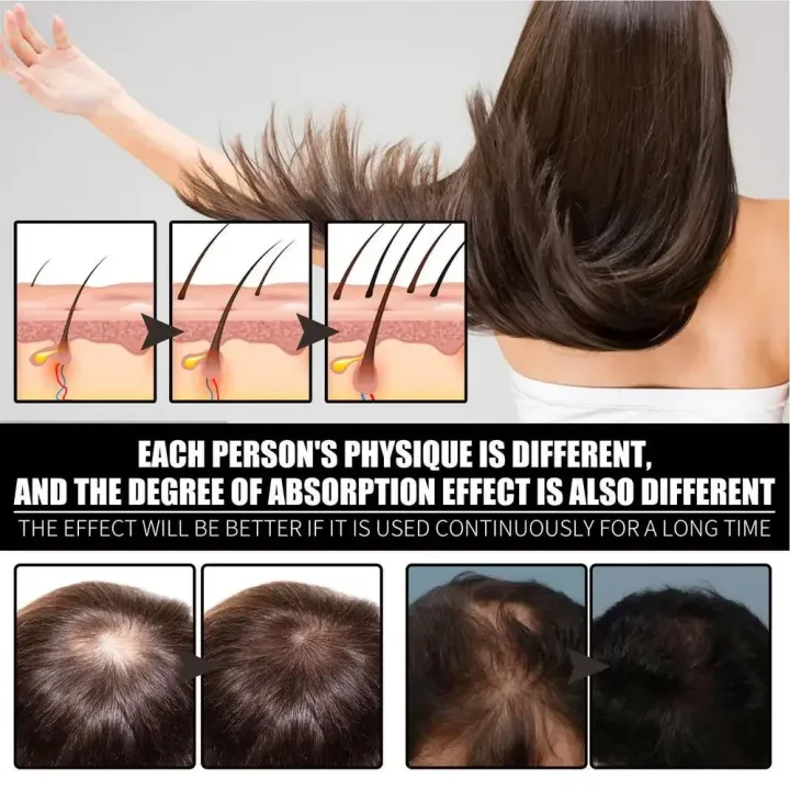 FORT%20%20Minoxidil%20Hair%20Growth%20Spray%20-%20Hair%20Tonic%20for%20Hair%20Care%20and%20Hair%20Growth%20-%20Premium%20Hair%20Care%20ProductWomen%20and%20Men%20all%20Hair%20Types%20-%20Image%205