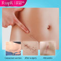 RtopR Scar Removal Cream Acne Scar Treatment Face Face Cream Repair Skin Care Stretch Burn Scar Remover Skin Repair Spots Body Skin Cream 15g. 