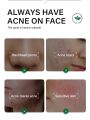 FORT Salicylic Acid Serum – Anti-Acne Face Serum & Dark Spot Correcting Serum for Glowing Skin | Acne Skin Care Products 30ml. 