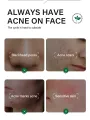 FORT Salicylic Acid Serum – Anti-Acne Face Serum & Dark Spot Correcting Serum for Glowing Skin | Acne Skin Care Products 30ml. 