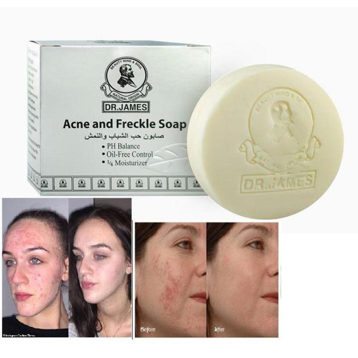 Dr. James Acne And Freckle Soap (Import From Thailand)