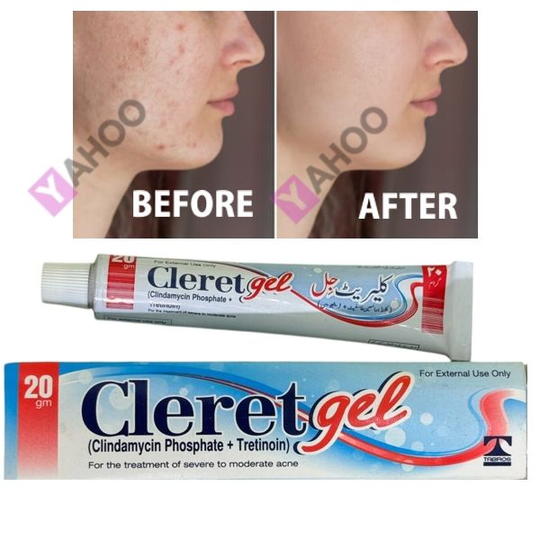 CLERET%20GEL%20(Clindamycin%20Phosphate%201%25%20+%20Tretinoin%200.025%25)%2020gm%20Dual-Action%20Prescription%20Acne%20Treatment%20-%20Image%202