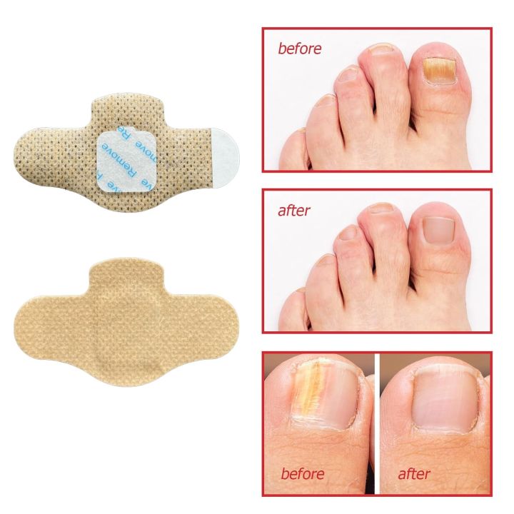 1%20SOLUTION%20SHOP%20Nail%20Fungal%20Treatment%20Patch%20%7C%20Anti%20Fungus%20Toe%20Nail%20Repair%20Strips%20%7C%20Overnight%20Hydrogel%20Patch%20for%20Yellow%20Nails,%20Cracked%20&%20Brittle%20Nail%20Care%20%7C%20Fast%20Nail%20Restoration%20%7C%2021%20Patches%20%7C%20Anti%20Infection%20Nail%20Protector%20for%20Healthy%20Shiny%20Toenails%20-%20Image%204