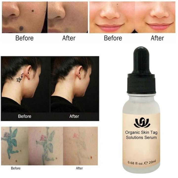 Painless Mole & Skin Tag Repair Solution Cream Oil