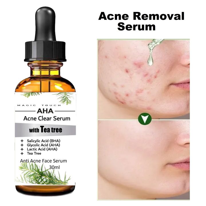 Magic Touch Real Salicylic Acid Anti Acne Face Serum – 2% Pure Salicylic Acid Oil Control, Dark Spot Corrector & Acne Removal | 30ml