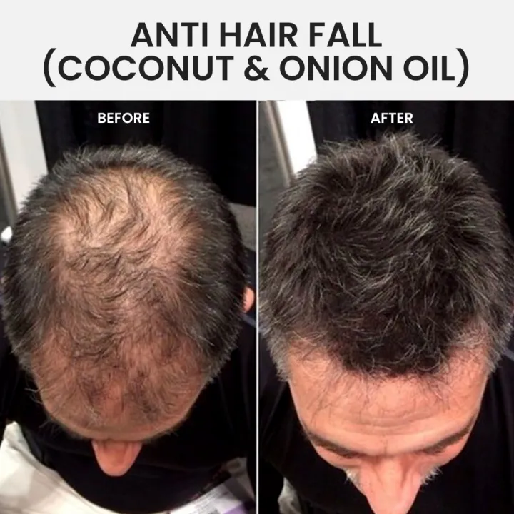 Anti%20Hair%20Fall%20Coconut%20&%20Onion%20Oil%20-%20Organic%20Oasis%20Hair%20Oil%20-%20Hair%20Growth%20oil%20-%20Anti%20Hair%20Loss%20&%20Hair%20Growth%20with%20Coconut%20Oil%20-%20130%20ml%20-%20Hair%20Care%20oil%20-%20Onion%20oil%20-%20Argan%20oil%20-%20Onion%20Extract%20oil%20for%20hair,%20-%20Image%206