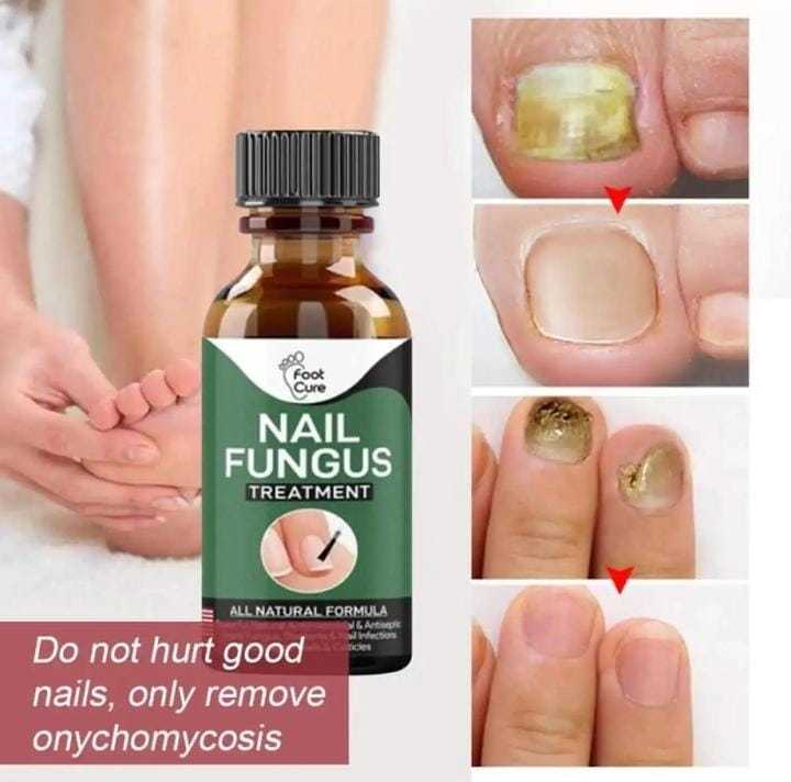 Fast%20Nail%20Fungal%20Treatments%20Nail%20Repair%20Essences%20Serum%20Care%20Treatments%20Foot%20Nail%20Fungus%20Removal%20Gel%20Paronychia%20Onychomycosis%20-%20Image%202