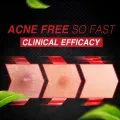 Garnier Men Acno Fight Anti-Pimple Face Wash 100ml - Suits All Skin Types, Including Sensitive And Acne-Related Skin Issues. 