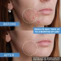 ADAPCO GEL (ADAPALENE GEL USP) For Acne  15gram Original. 