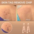 12Pcs Copper Skin Tag Remover Clips Wart Tag Extractor Copper Tag Out. 