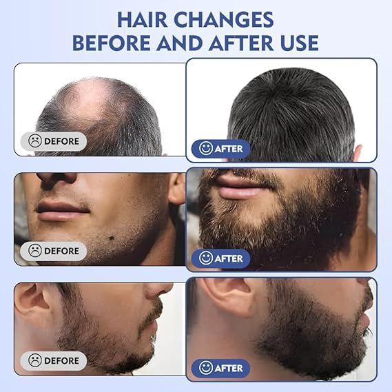 Derma%20Micro%20Needle%20Stamp,%20Derma%20Stamp%20Adjustable%200-3mm%20140%20Titanium%20Needles%20Professional%20Derma%20Stamping%20for%20Skin,%20Eyebrows%20and%20Scalp%20Care%20-%20Image%207