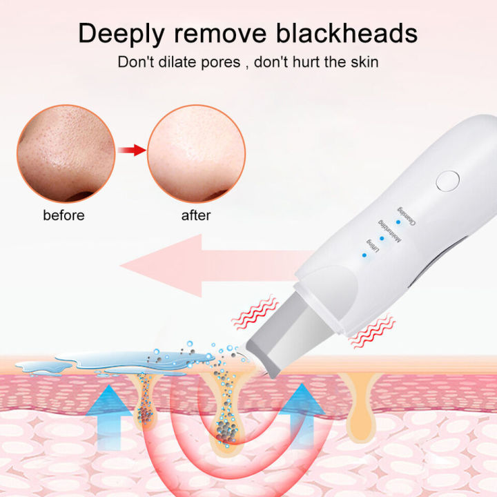 Ultrasonic%20Blackhead%20Removal%20Device%20Rechargeable%20Skin%20leather%20Shovel%20Machine%20Ultrasonic%20Facial%20Skin%20Scrubber%20Blackheads%20Remover%20Machine%20Removes%20Blackheads,%20Acne,%20Pimple,%20Black%20Spots%20%7C%20Deep%20Face%20Lifting,%20Moisturizing,%20Cleansing%20-%20Face%20Lifting%20Device%20-%20Image%205