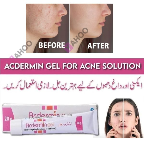 Acdermin Gel 20g – Targeted Acne Treatment