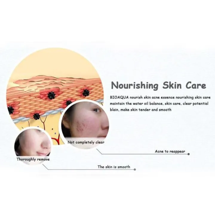 ORANGLES Bioaqua Pure Skin Anti Acne Serum Facial Removal Solution 30Ml - angled perspective - presenting advantages - Image 4 of 4 | fits any environment | Purchase Bioaqua Pure Skin Anti Acne Serum Facial Removal Solution 30Ml Michigan | Free Shipping ORANGLES