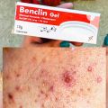 Benclin Gel for Acne - Black head remover cream - Acne scars remover cream. 