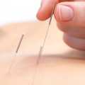 Acupuncture Needles (Dry Needles Physiotherapy) (Size 0.35x75) 3 CUN, 100 Needles Pack with Guided Tube. 