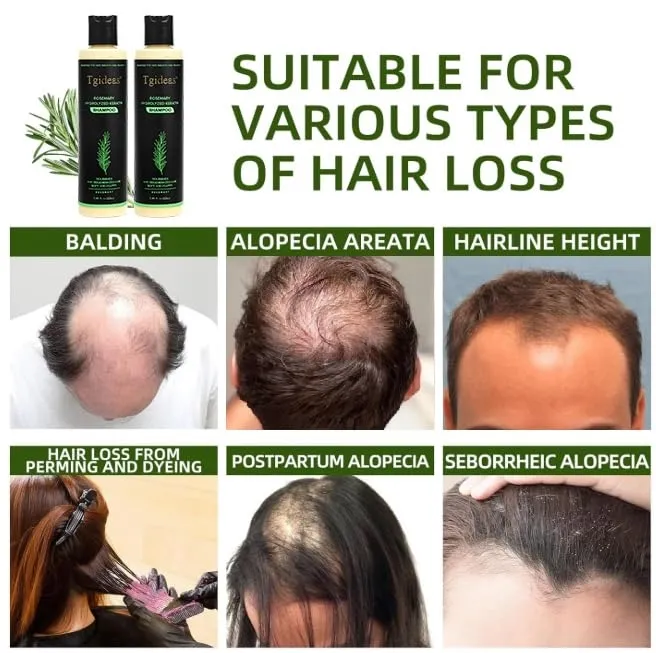 Tgideas%20Organic%20Rosemary%20Hair%20Growth%20Shampoo%20for%20Women%20and%20Men-Natural%20Thickening%20&%20Strengthening%20Shampoo%20with%20Hydrolyzed%20Keratin%20for%20Thinning%20Hair%20&%20Hair%20Loss%207.4%20fl.oz%20-%20Image%205