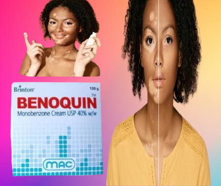 Benoquin%20Monobenzone%20Cream%20New%20In%20Pakistan%20-%20Image%202