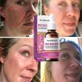 Organic Rosehip Seed Oil For Face-Pure Cold Pressed Facial Oil,Natural Non-Greasy Moisturizing Face Skin Care Serum New. 
