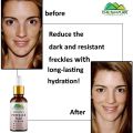 Freckles Fade Serum – Hydrates Skin, Fade Freckles, Reduce Blemishes & Lighten Pigmentation. 