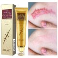 Acne Scar Removal Cream Pimples Stretch Marks Face Cream Gel Repairing Smoothing Whitening Moisturizing Body Cream Skin Care. 