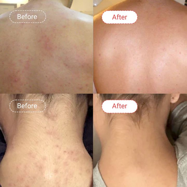 AccuFix%20Cosmetics%20AHA/BHA%20Body%20Wash%20(300g)%20%7C%20Acne%20Body%20Wash%20%7C%20Anti-acne%20%7C%20Rough%20Skin%20-%20Image%205