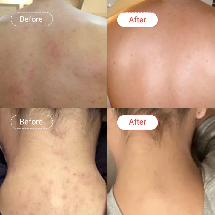 AccuFix%20Cosmetics%20AHA/BHA%20Body%20Wash%20(300g)%20%7C%20Acne%20Body%20Wash%20%7C%20Anti-acne%20%7C%20Rough%20Skin%20-%20Image%205