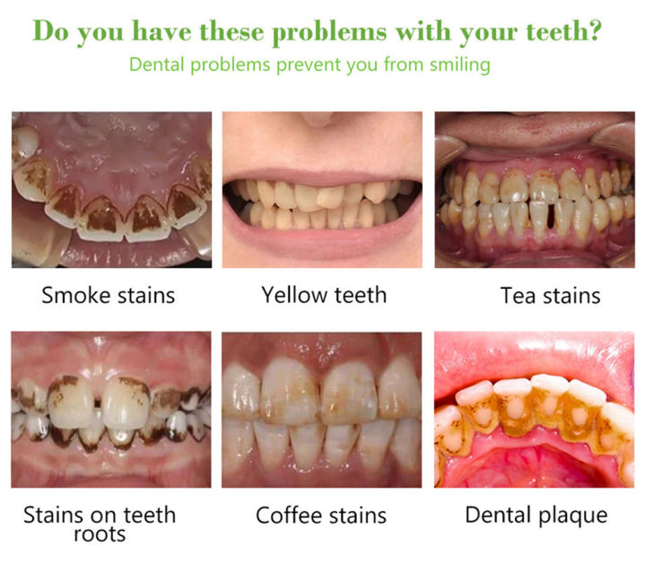 10ML%20Teeth%20Whitening%20Toothpaste%20Dental%20Oral%20Hygiene%20Remove%20Stains%20Plaque%20Teeth%20Cleaning%20Tooth%20Tool%20-%20Image%207