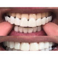SowSmile Soft Silicone Gel Dental Oral Upper Lower False Teeth Cover Perfect Smile Veneers Dentures Braces Equipment Mold BruberryBeE. 
